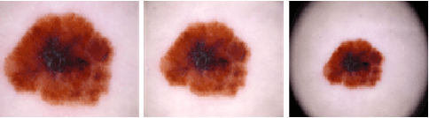 Figure 1 for Transfer learning with class-weighted and focal loss function for automatic skin cancer classification