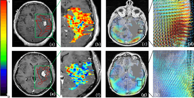 Figure 3 for Radiomic Deformation and Textural Heterogeneity (R-DepTH) Descriptor to characterize Tumor Field Effect: Application to Survival Prediction in Glioblastoma