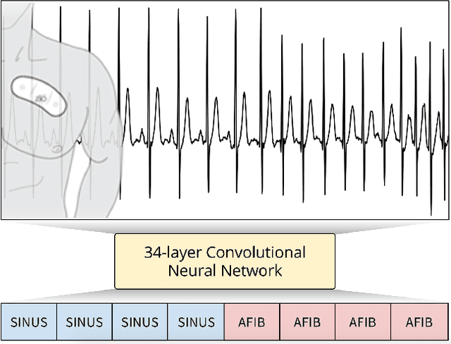 Figure 1 for Cardiologist-Level Arrhythmia Detection with Convolutional Neural Networks