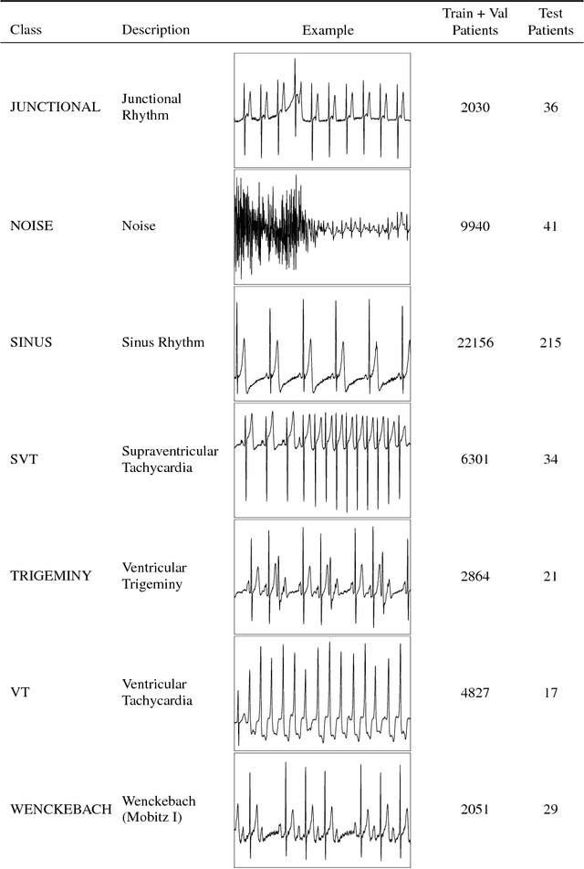 Figure 4 for Cardiologist-Level Arrhythmia Detection with Convolutional Neural Networks