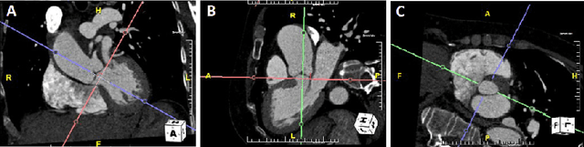 Figure 1 for Automated cross-sectional view selection in CT angiography of aortic dissections with uncertainty awareness and retrospective clinical annotations