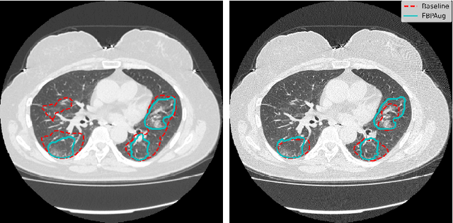 Figure 4 for Zero-Shot Domain Adaptation in CT Segmentation by Filtered Back Projection Augmentation