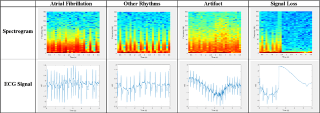 Figure 1 for Atrial Fibrillation Detection Using Deep Features and Convolutional Networks