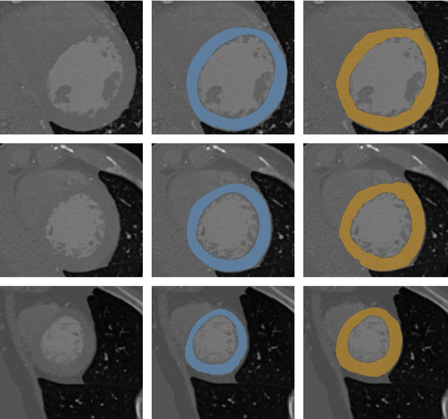 Figure 3 for Automatic Segmentation of the Left Ventricle in Cardiac CT Angiography Using Convolutional Neural Network