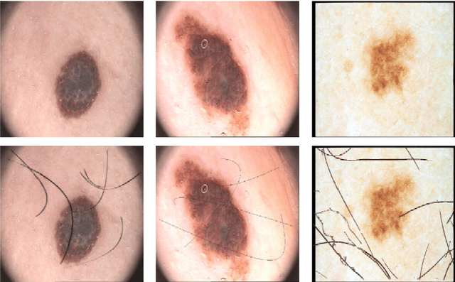 Figure 3 for An Encoder-Decoder CNN for Hair Removal in Dermoscopic Images