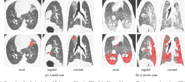 Figure 1 for Semi-Supervised Segmentation of Radiation-Induced Pulmonary Fibrosis from Lung CT Scans with Multi-Scale Guided Dense Attention