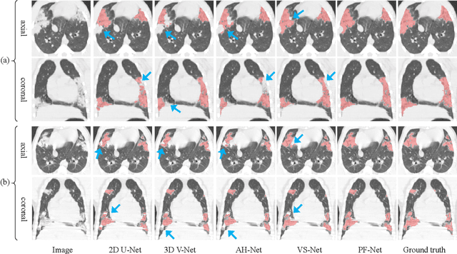 Figure 4 for Semi-Supervised Segmentation of Radiation-Induced Pulmonary Fibrosis from Lung CT Scans with Multi-Scale Guided Dense Attention