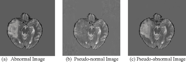 Figure 1 for Where is the disease? Semi-supervised pseudo-normality synthesis from an abnormal image