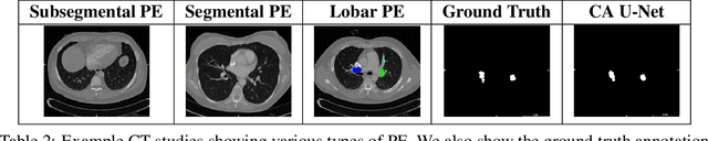 Figure 4 for Pi-PE: A Pipeline for Pulmonary Embolism Detection using Sparsely Annotated 3D CT Images