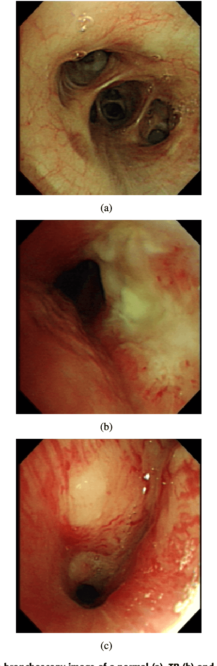 Figure 1 for Optimize transfer learning for lung diseases in bronchoscopy using a new concept: sequential fine-tuning