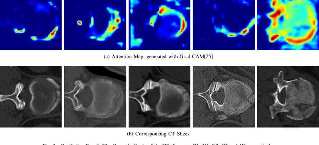 Figure 3 for Faint Features Tell: Automatic Vertebrae Fracture Screening Assisted by Contrastive Learning