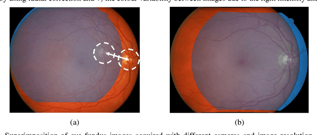 Figure 1 for Superimposition of eye fundus images for longitudinal analysis from large public health databases