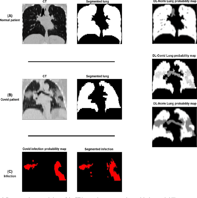 Figure 2 for A novel unsupervised covid lung lesion segmentation based on the lung tissue identification