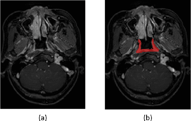 Figure 1 for DSU-net: Dense SegU-net for automatic head-and-neck tumor segmentation in MR images