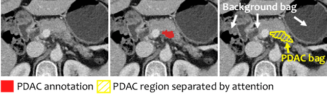 Figure 2 for Learning Inductive Attention Guidance for Partially Supervised Pancreatic Ductal Adenocarcinoma Prediction
