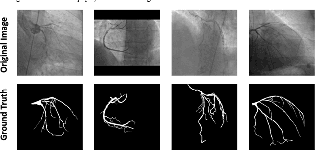 Figure 1 for A new approach to extracting coronary arteries and detecting stenosis in invasive coronary angiograms