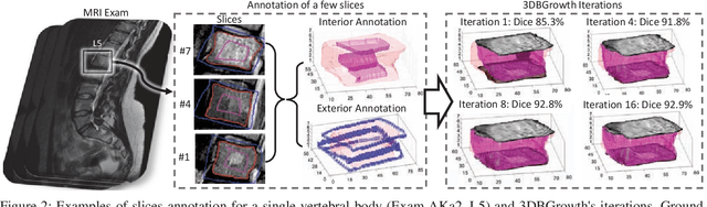 Figure 2 for 3DBGrowth: volumetric vertebrae segmentation and reconstruction in magnetic resonance imaging