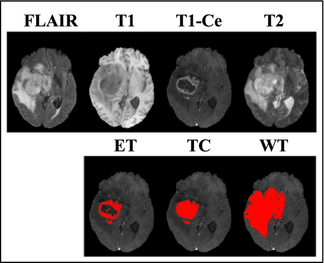 Figure 1 for Quantifying U-Net Uncertainty in Multi-Parametric MRI-based Glioma Segmentation by Spherical Image Projection