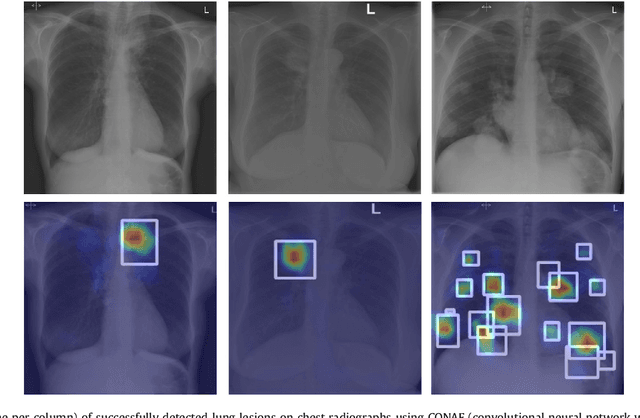 Figure 1 for Learning to detect chest radiographs containing lung nodules using visual attention networks
