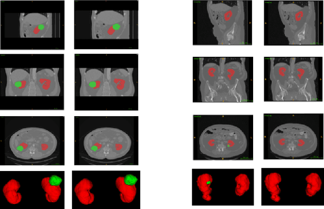 Figure 4 for Multi Scale Supervised 3D U-Net for Kidney and Tumor Segmentation