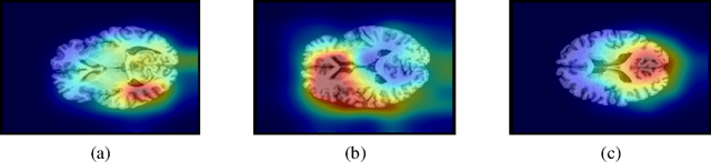 Figure 4 for Classification of Alzheimer's Disease Using the Convolutional Neural Network (CNN) with Transfer Learning and Weighted Loss