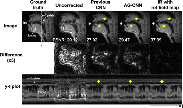Figure 4 for Attention-gated convolutional neural networks for off-resonance correction of spiral real-time MRI