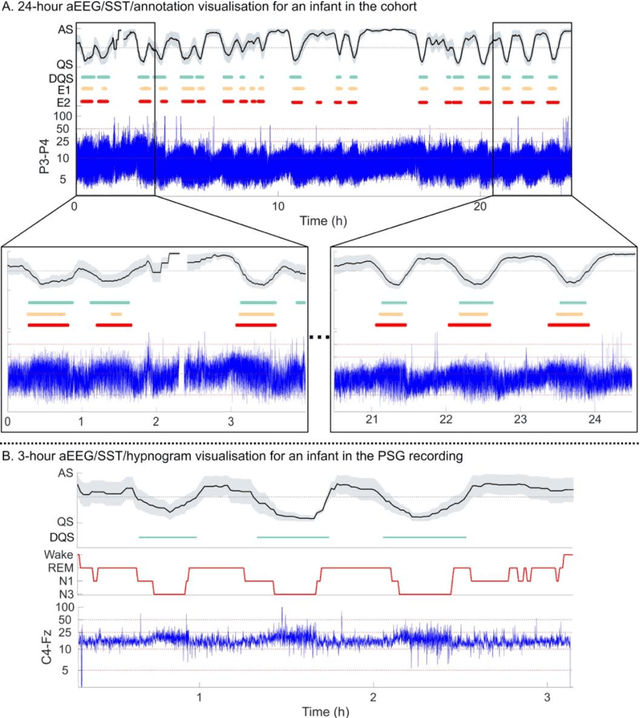 Figure 4 for Development of Sleep State Trend (SST), a bedside measure of neonatal sleep state fluctuations based on single EEG channels