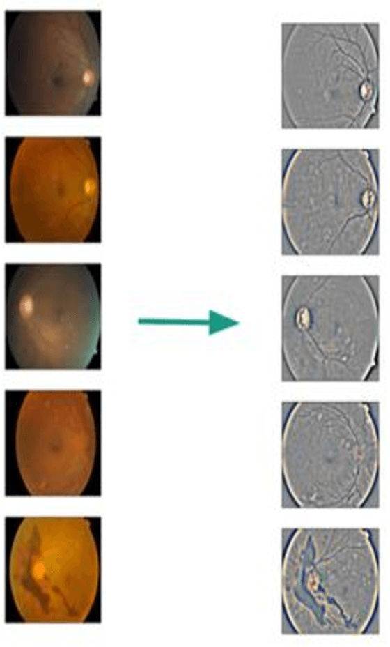 Figure 1 for Classification of Diabetic Retinopathy via Fundus Photography: Utilization of Deep Learning Approaches to Speed up Disease Detection