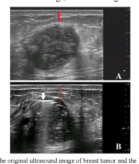 Figure 1 for Research on the Detection Method of Breast Cancer Deep Convolutional Neural Network Based on Computer Aid