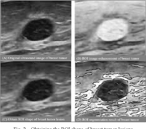 Figure 2 for Research on the Detection Method of Breast Cancer Deep Convolutional Neural Network Based on Computer Aid