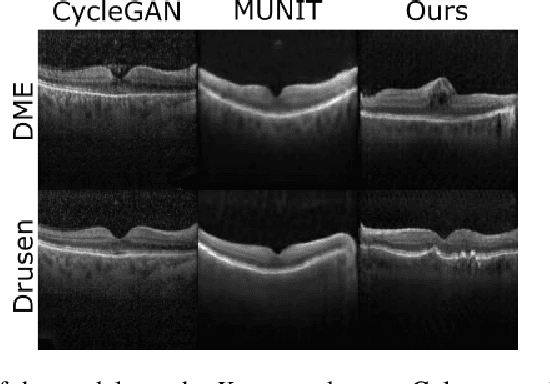 Figure 4 for Unsupervised Image to Image Translation for Multiple Retinal Pathology Synthesis in Optical Coherence Tomography Scans