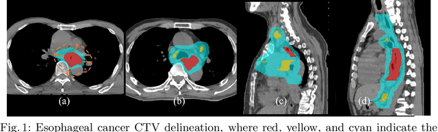 Figure 1 for Deep Esophageal Clinical Target Volume Delineation using Encoded 3D Spatial Context of Tumors, Lymph Nodes, and Organs At Risk