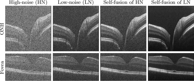 Figure 1 for Retinal OCT Denoising with Pseudo-Multimodal Fusion Network