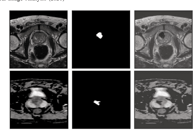 Figure 1 for Self-transfer learning via patches: A prostate cancer triage approach based on bi-parametric MRI