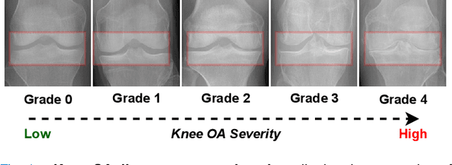 Figure 1 for Knee Osteoarthritis Severity Prediction using an Attentive Multi-Scale Deep Convolutional Neural Network