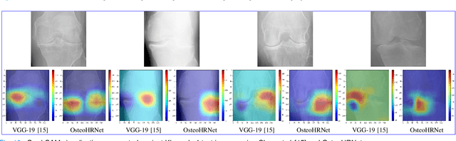 Figure 2 for Knee Osteoarthritis Severity Prediction using an Attentive Multi-Scale Deep Convolutional Neural Network