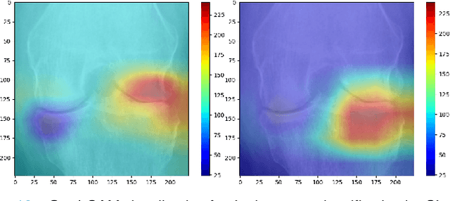 Figure 4 for Knee Osteoarthritis Severity Prediction using an Attentive Multi-Scale Deep Convolutional Neural Network