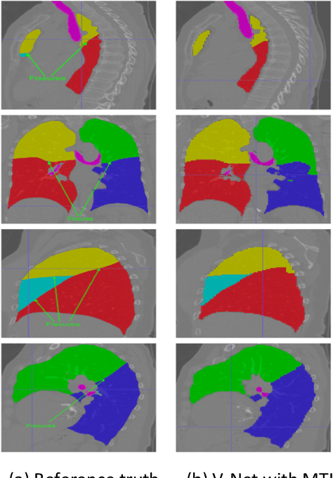 Figure 3 for Development of a Multi-Task Learning V-Net for Pulmonary Lobar Segmentation on Computed Tomography and Application to Diseased Lungs