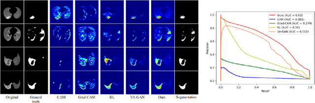 Figure 2 for Towards Unbiased COVID-19 Lesion Localisation and Segmentation via Weakly Supervised Learning