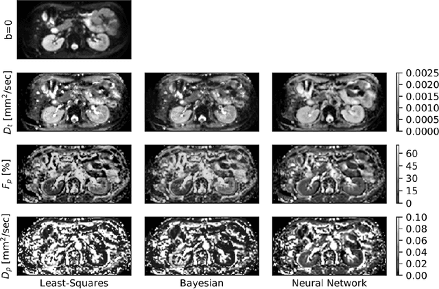 Figure 1 for Deep Learning How to Fit an Intravoxel Incoherent Motion Model to Diffusion-Weighted MRI