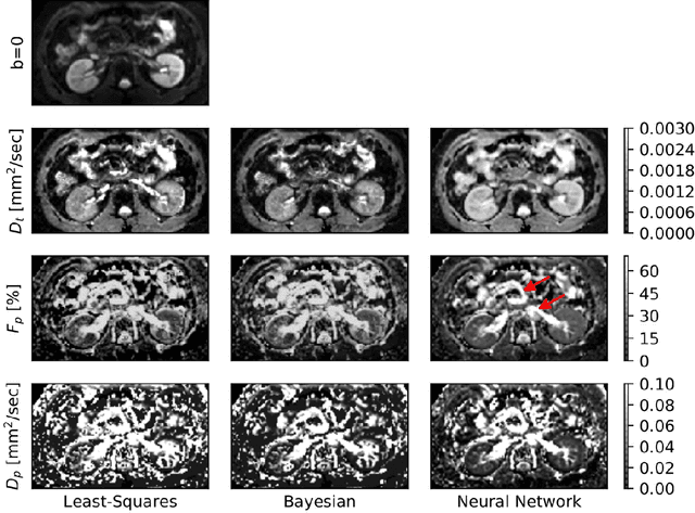 Figure 3 for Deep Learning How to Fit an Intravoxel Incoherent Motion Model to Diffusion-Weighted MRI