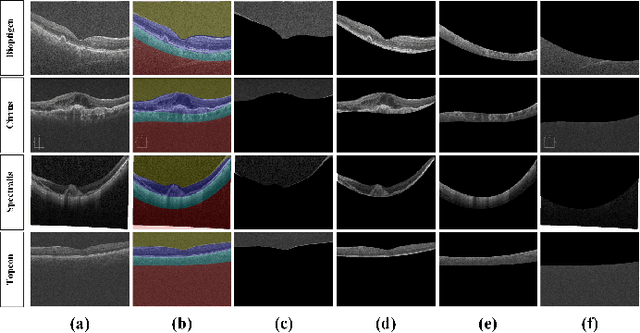 Figure 3 for Automated segmentation and extraction of posterior eye segment using OCT scans
