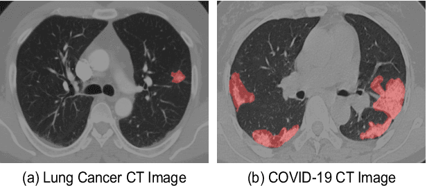 Figure 1 for A Teacher-Student Framework with Fourier Augmentation for COVID-19 Infection Segmentation in CT Images