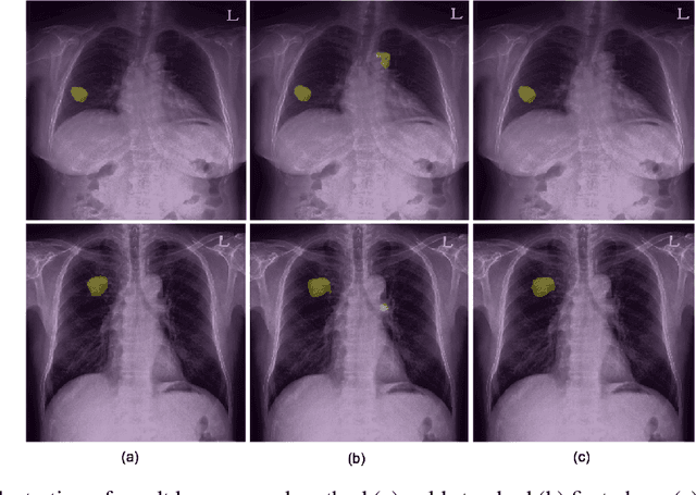 Figure 3 for False Positive Reduction by Actively Mining Negative Samples for Pulmonary Nodule Detection in Chest Radiographs