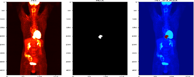 Figure 1 for Weakly Supervised PET Tumor Detection Using Class Response