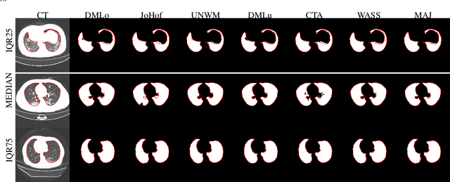 Figure 2 for Comparative study of deep learning methods for the automatic segmentation of lung, lesion and lesion type in CT scans of COVID-19 patients