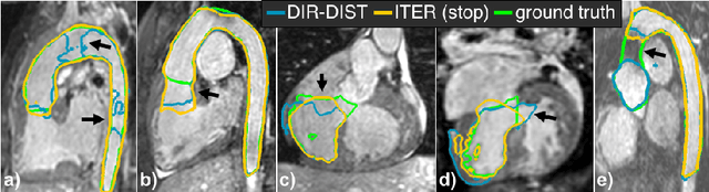 Figure 3 for Iterative Segmentation from Limited Training Data: Applications to Congenital Heart Disease