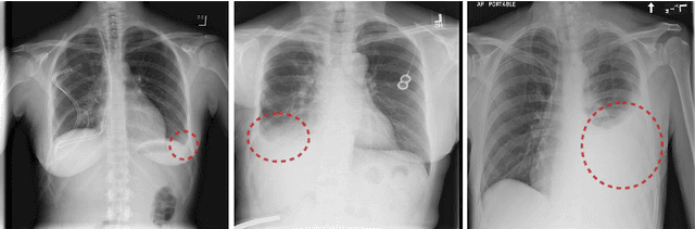 Figure 1 for Attention-Guided Curriculum Learning for Weakly Supervised Classification and Localization of Thoracic Diseases on Chest Radiographs