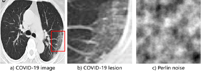 Figure 1 for Learning from Pseudo Lesion: A Self-supervised Framework for COVID-19 Diagnosis