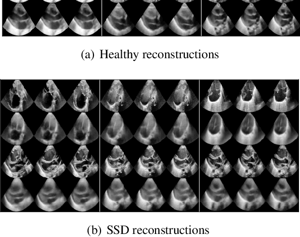 Figure 3 for Interpretable Anomaly Detection in Echocardiograms with Dynamic Variational Trajectory Models